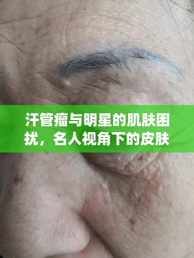汗管瘤与明星的肌肤困扰,名人视角下的皮肤问题解析